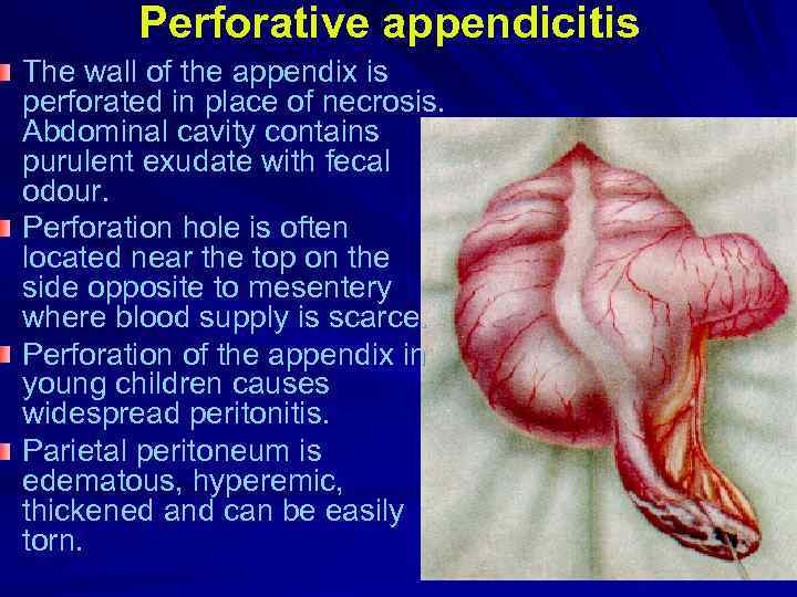 Perforative appendicitis The wall of the appendix is perforated in place of necrosis. Abdominal
