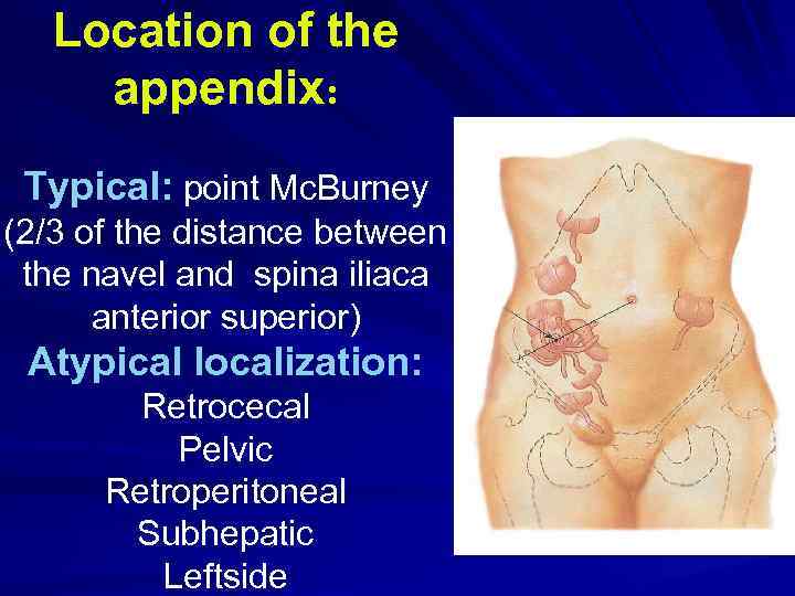 Location of the appendix: Typical: point Mc. Burney (2/3 of the distance between the