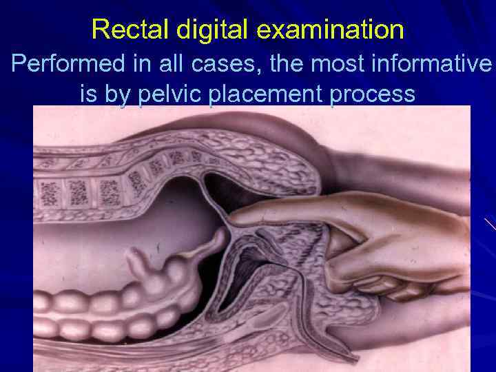 Rectal digital examination Performed in all cases, the most informative is by pelvic placement
