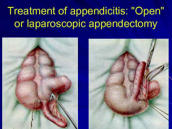 Treatment of appendicitis: 