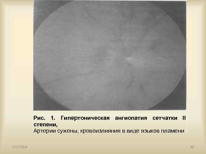 Рис. 1. Гипертоническая ангиопатия сетчатки II степени, Артерии сужены, кровоизлияния в виде языков пламени