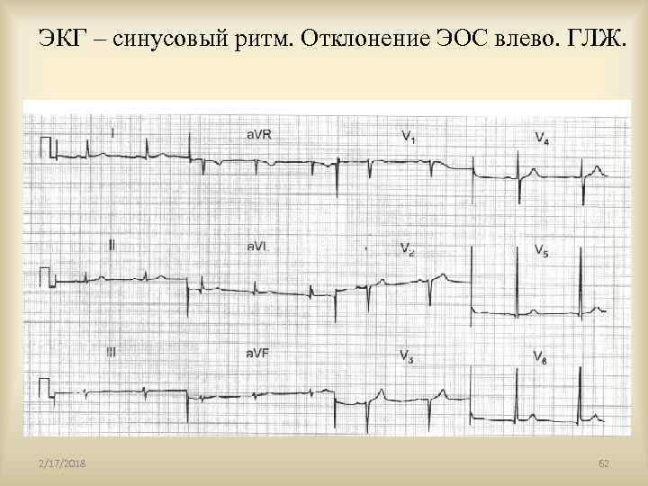 ЭКГ – синусовый ритм. Отклонение ЭОС влево. ГЛЖ. 2/17/2018 62 