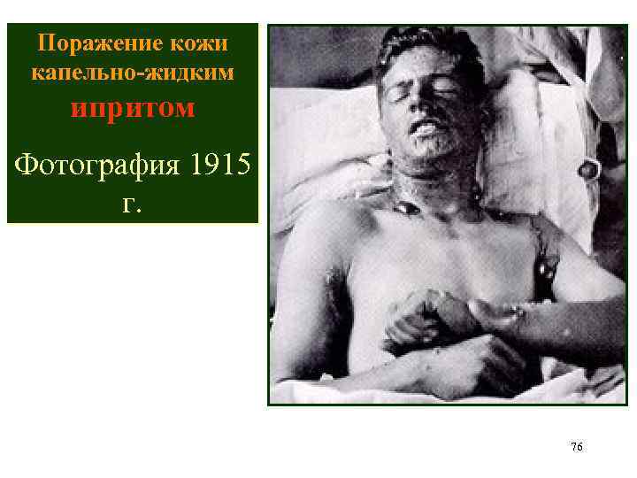 Поражение кожи капельно-жидким ипритом Фотография 1915 г. 76 