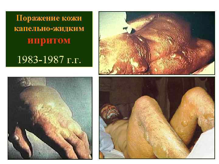Поражение кожи капельно-жидким ипритом 1983 -1987 г. г. 77 