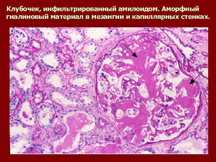 Клубочек, инфильтрированный амилоидом. Аморфный гиалиновый материал в мезангии и капиллярных стенках. 