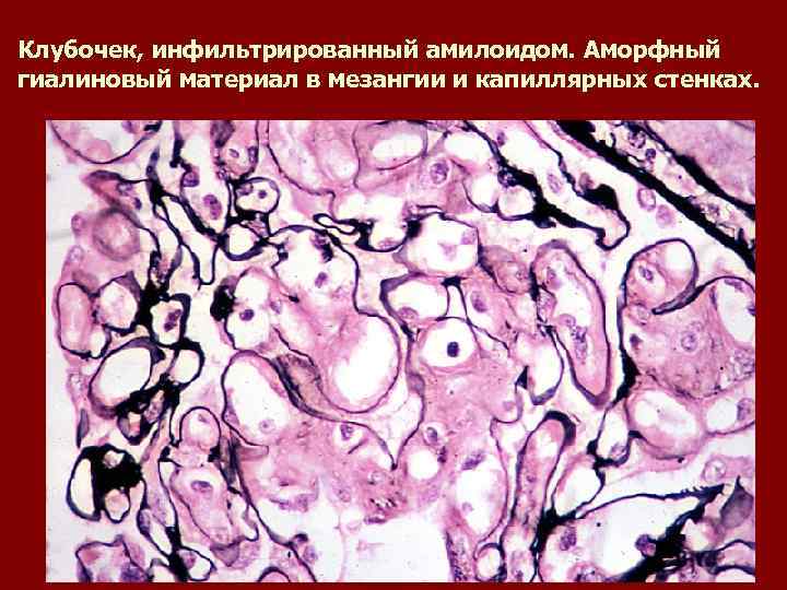 Клубочек, инфильтрированный амилоидом. Аморфный гиалиновый материал в мезангии и капиллярных стенках. 