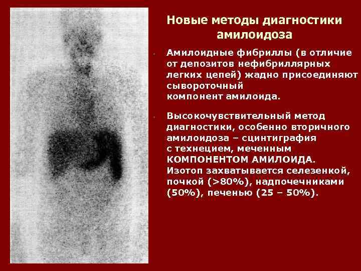 Новые методы диагностики амилоидоза • • Амилоидные фибриллы (в отличие от депозитов нефибриллярных легких
