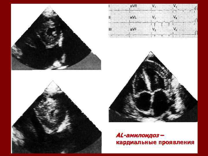 AL-амилоидоз – кардиальные проявления 
