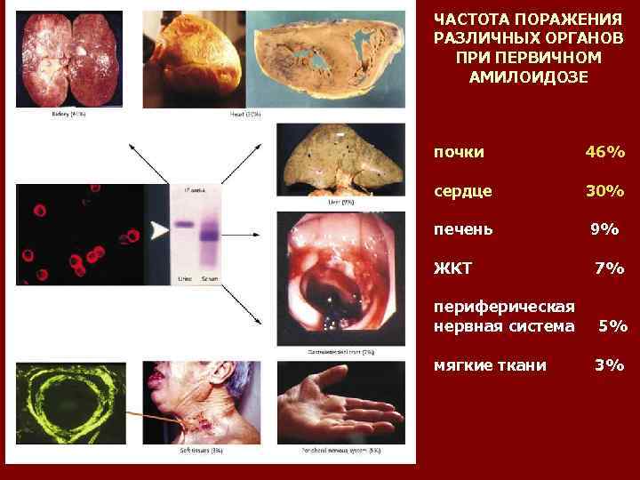 ЧАСТОТА ПОРАЖЕНИЯ РАЗЛИЧНЫХ ОРГАНОВ ПРИ ПЕРВИЧНОМ АМИЛОИДОЗЕ почки 46% сердце 30% печень 9% ЖКТ