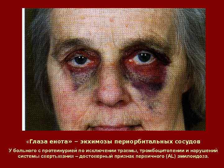  «Глаза енота» – экхимозы периорбитальных сосудов У больного с протеинурией по исключении травмы,
