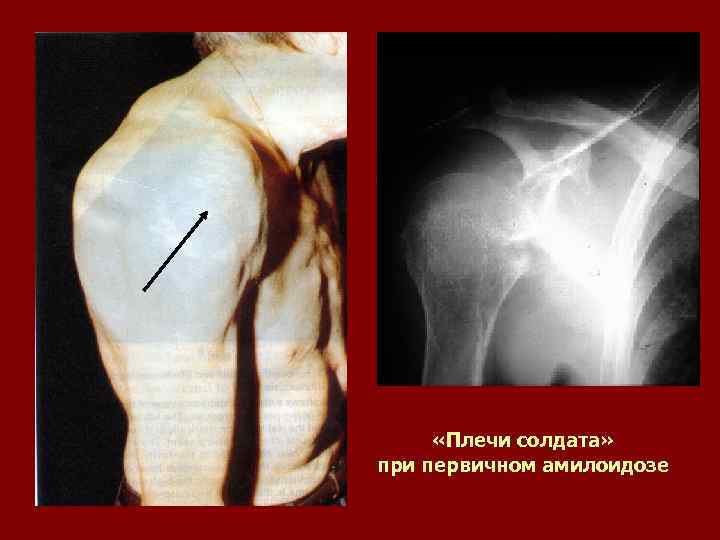  «Плечи солдата» при первичном амилоидозе 