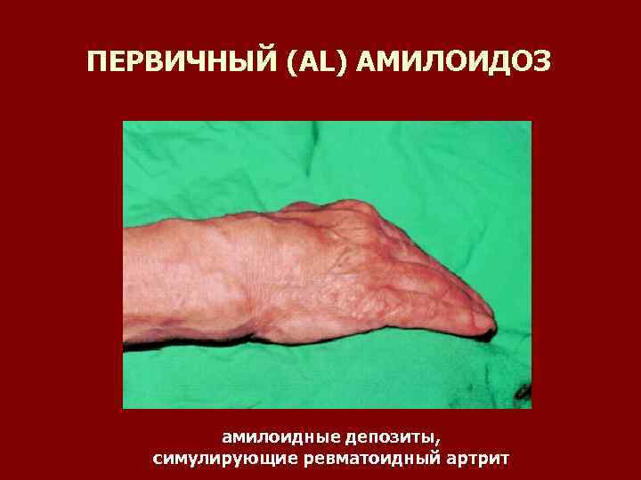 ПЕРВИЧНЫЙ (AL) АМИЛОИДОЗ амилоидные депозиты, симулирующие ревматоидный артрит 