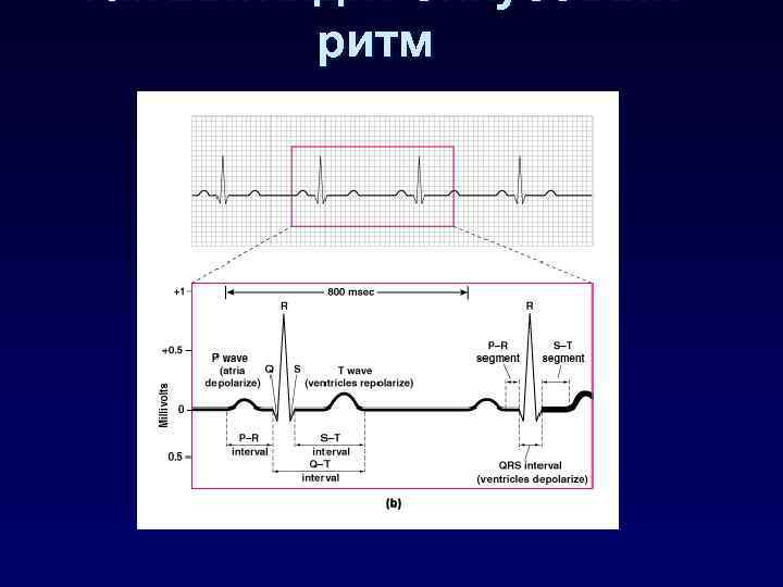 Так выглядит синусовый ритм 