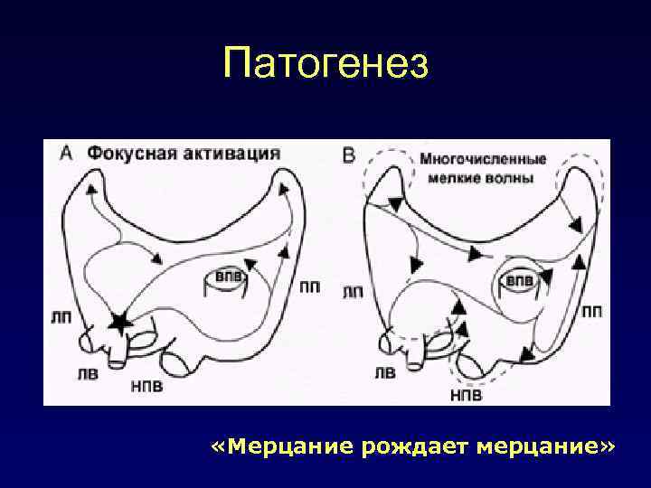 Патогенез «Мерцание рождает мерцание» 