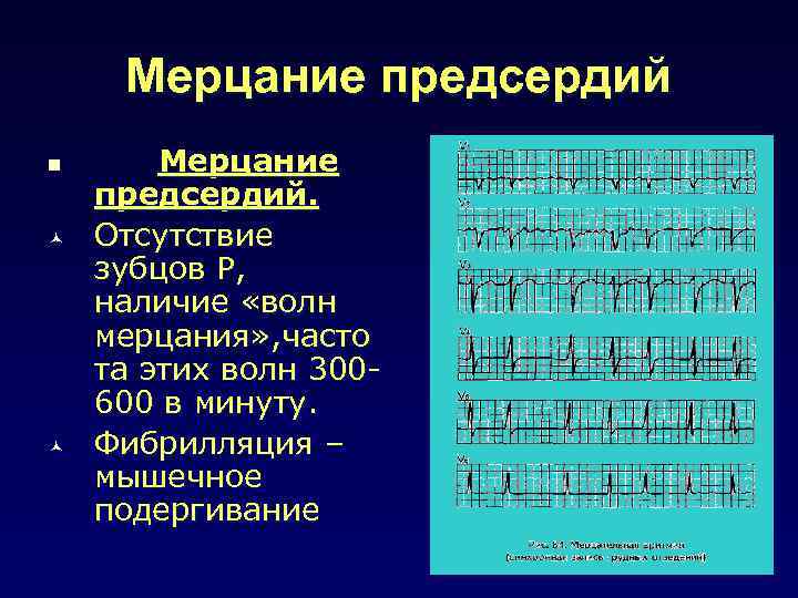 Мерцание предсердий n © © Мерцание предсердий. Отсутствие зубцов Р, наличие «волн мерцания» ,