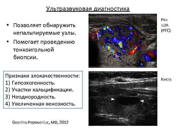 Ультразвуковая диагностика • Позволяет обнаружить непальпируемые узлы. • Помогает проведению тонкоигольной биопсии. Признаки злокачественности: