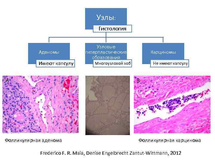 Узлы: Гистология Аденомы Имеют капсулу Фолликулярная аденома Узловые гиперпластические образования Многоузловой зоб Карциномы Не
