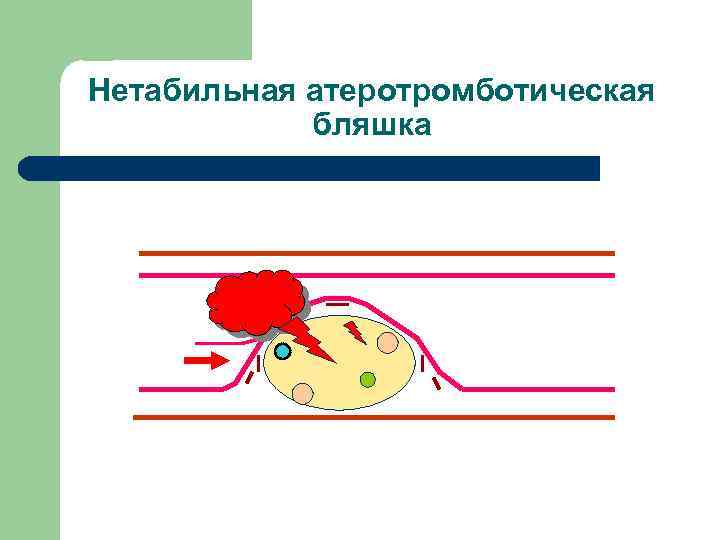 Нетабильная атеротромботическая бляшка 