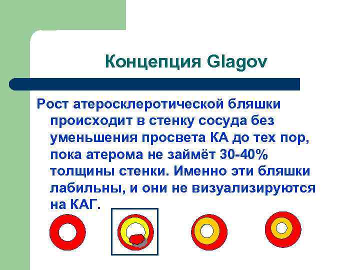 Концепция Glagov Рост атеросклеротической бляшки происходит в стенку сосуда без уменьшения просвета КА до