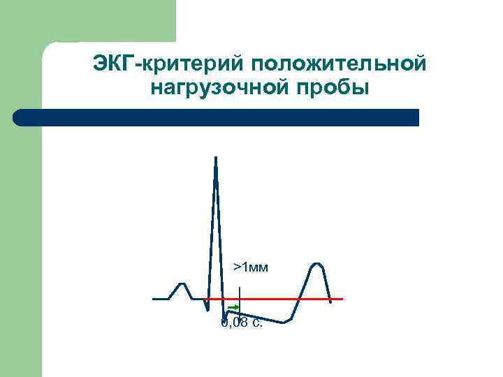 ЭКГ-критерий положительной нагрузочной пробы >1 мм 0, 08 с. 