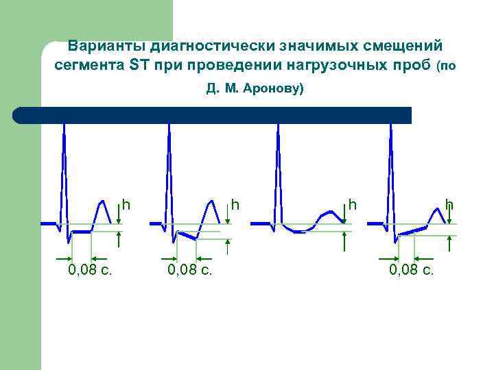 Варианты диагностически значимых смещений сегмента ST при проведении нагрузочных проб (по Д. М. Аронову)