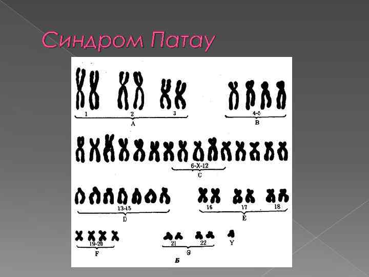 Синдром Патау 