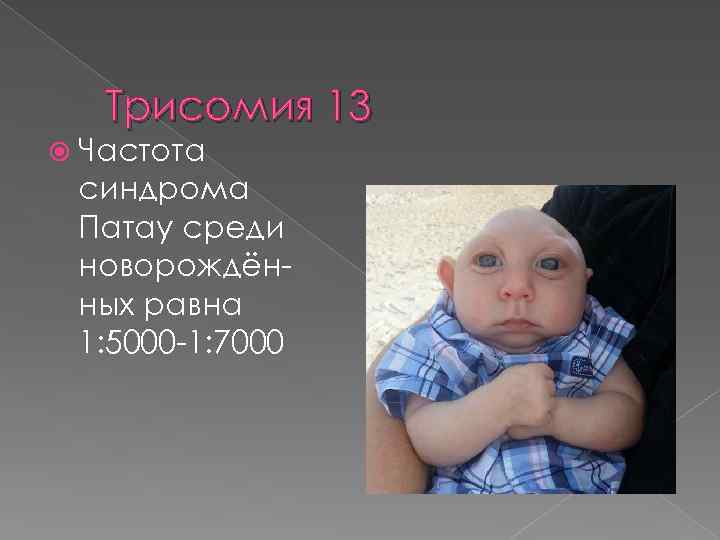 Трисомия 13 Частота синдрома Патау среди новорождённых равна 1: 5000 -1: 7000 