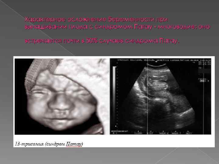 Характерное осложнение беременности при вынашивании плода с синдромом Патау - многоводие: оно встречается почти