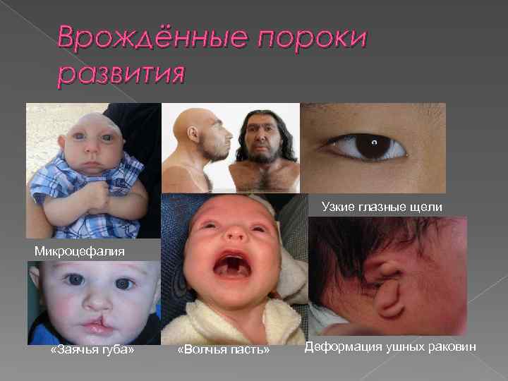 Врождённые пороки развития Низкий, скошенный лоб Узкие глазные щели Микроцефалия «Заячья губа» «Волчья пасть»