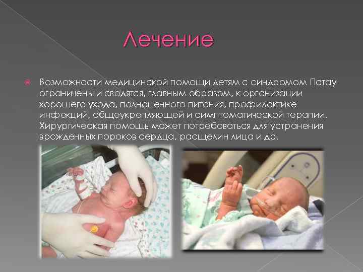 Лечение Возможности медицинской помощи детям с синдромом Патау ограничены и сводятся, главным образом, к