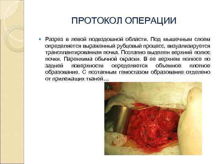 ПРОТОКОЛ ОПЕРАЦИИ Разрез в левой подвздошной области. Под мышечным слоем определяется выраженный рубцовый процесс,