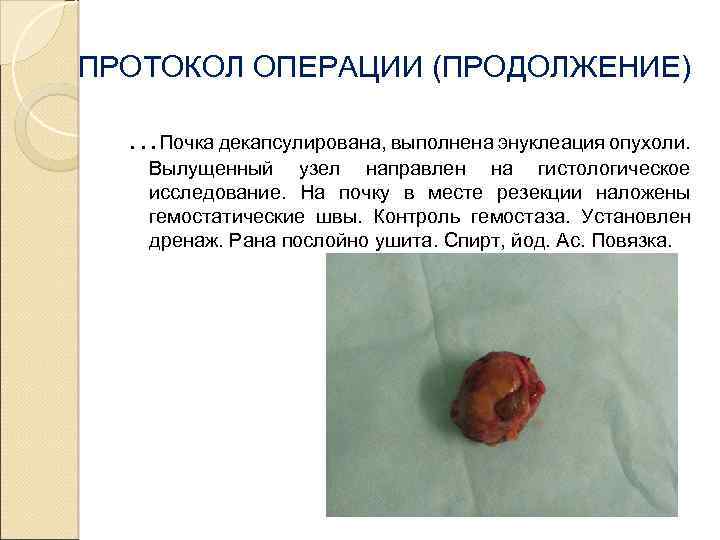ПРОТОКОЛ ОПЕРАЦИИ (ПРОДОЛЖЕНИЕ) …Почка декапсулирована, выполнена энуклеация опухоли. Вылущенный узел направлен на гистологическое исследование.