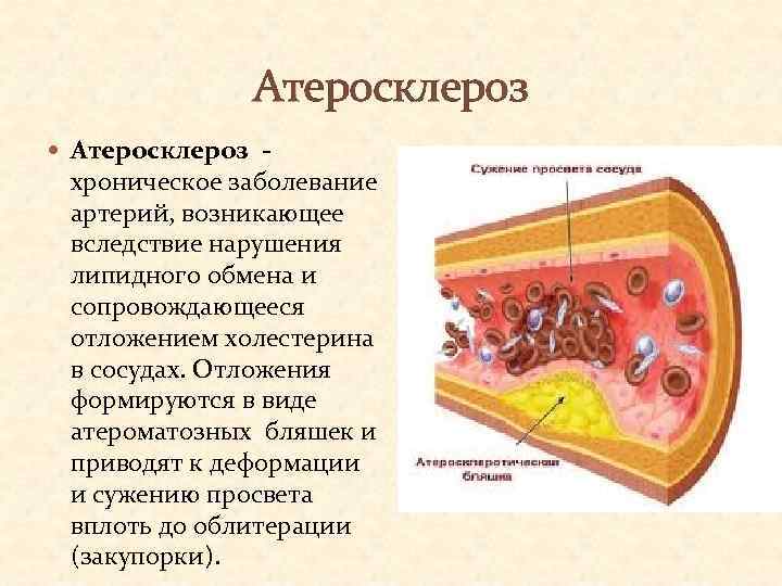 Атеросклероз - хроническое заболевание артерий, возникающее вследствие нарушения липидного обмена и сопровождающееся отложением холестерина