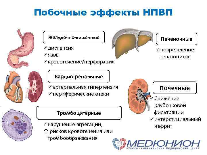 Побочные эффекты НПВП Желудочно-кишечные ü диспепсия ü язвы ü кровотечение/перфорация Печеночные ü повреждение гепатоцитов