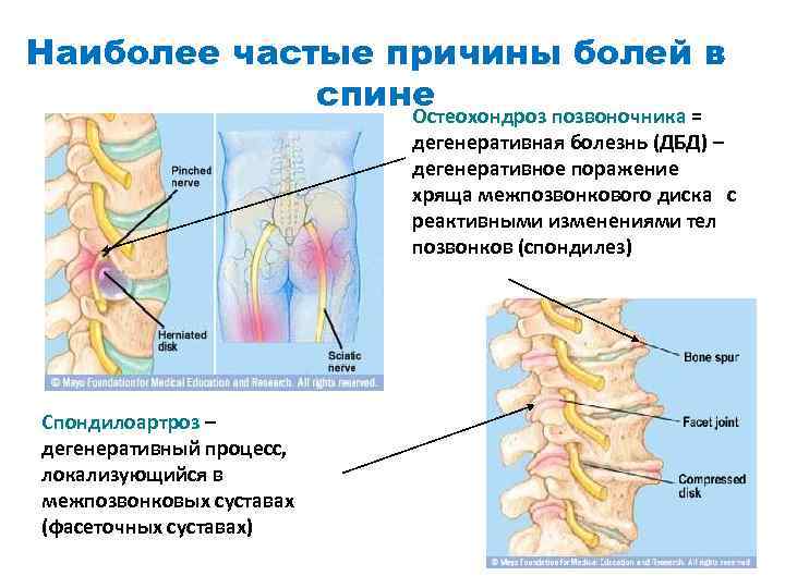 Наиболее частые причины болей в спине Остеохондроз позвоночника = дегенеративная болезнь (ДБД) – дегенеративное