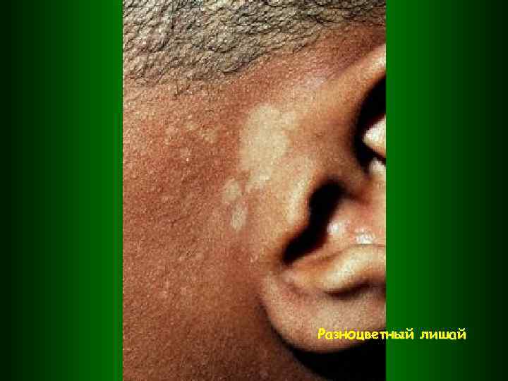 Разноцветный лишай 