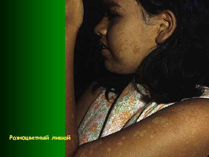 Разноцветный лишай 