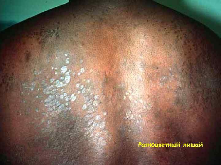 Разноцветный лишай 