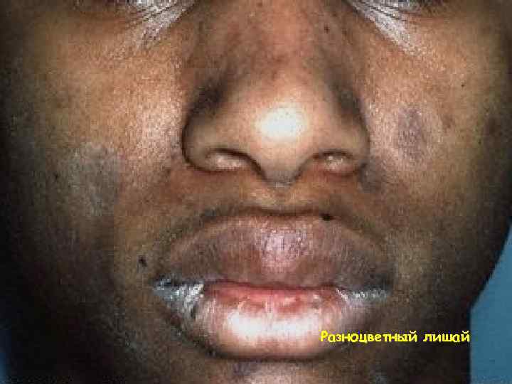 Разноцветный лишай 