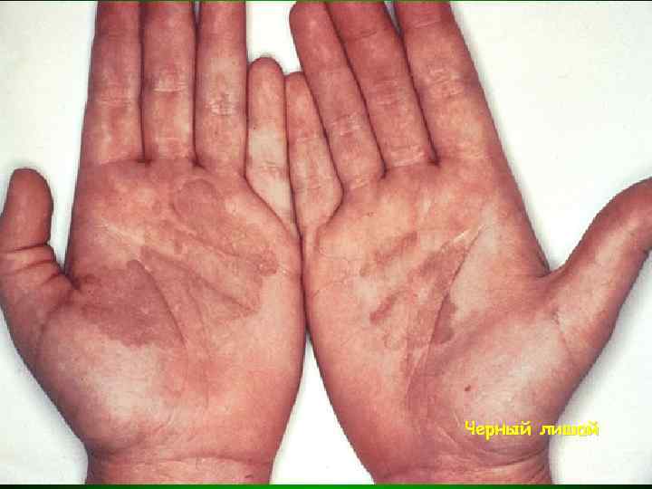Черный лишай 