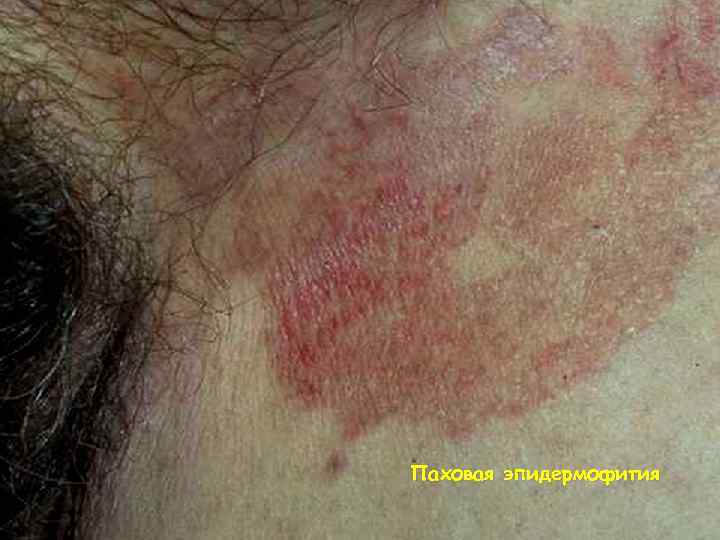 Паховая эпидермофития 