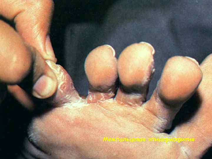 Межпальцевая эпидермофития 