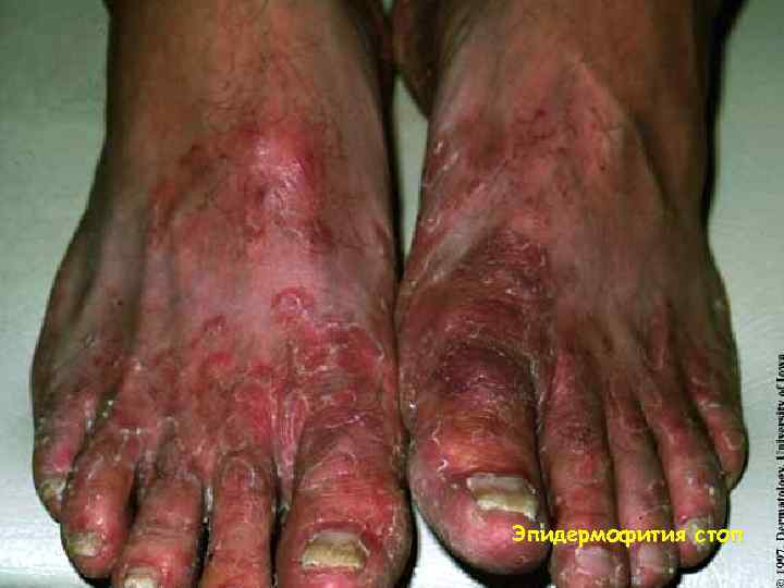 Эпидермофития стоп 