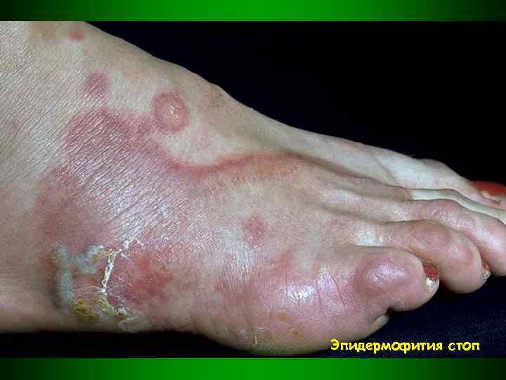 Эпидермофития стоп 