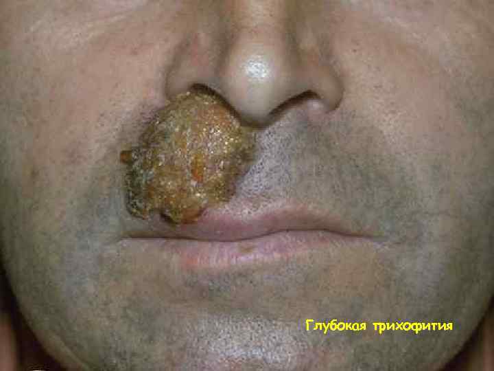 Глубокая трихофития 