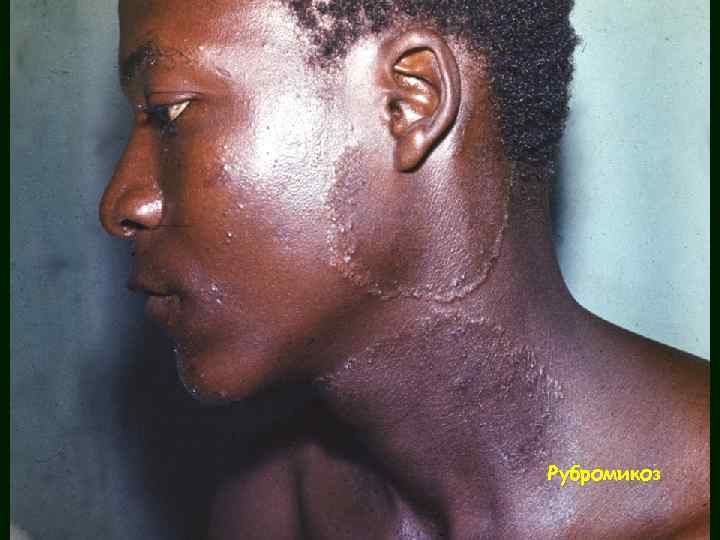 Рубромикоз 