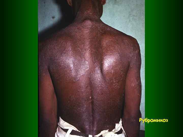 Рубромикоз 