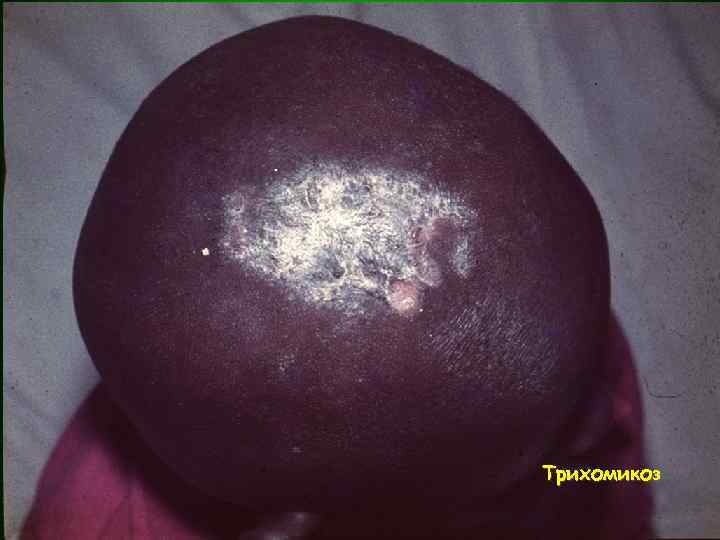 Трихомикоз 