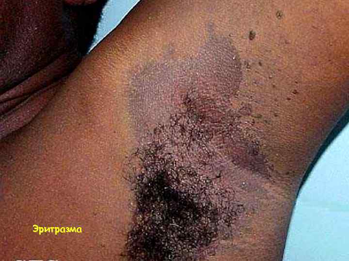 Эритразма 