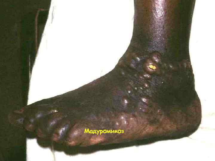 Мадуромикоз 